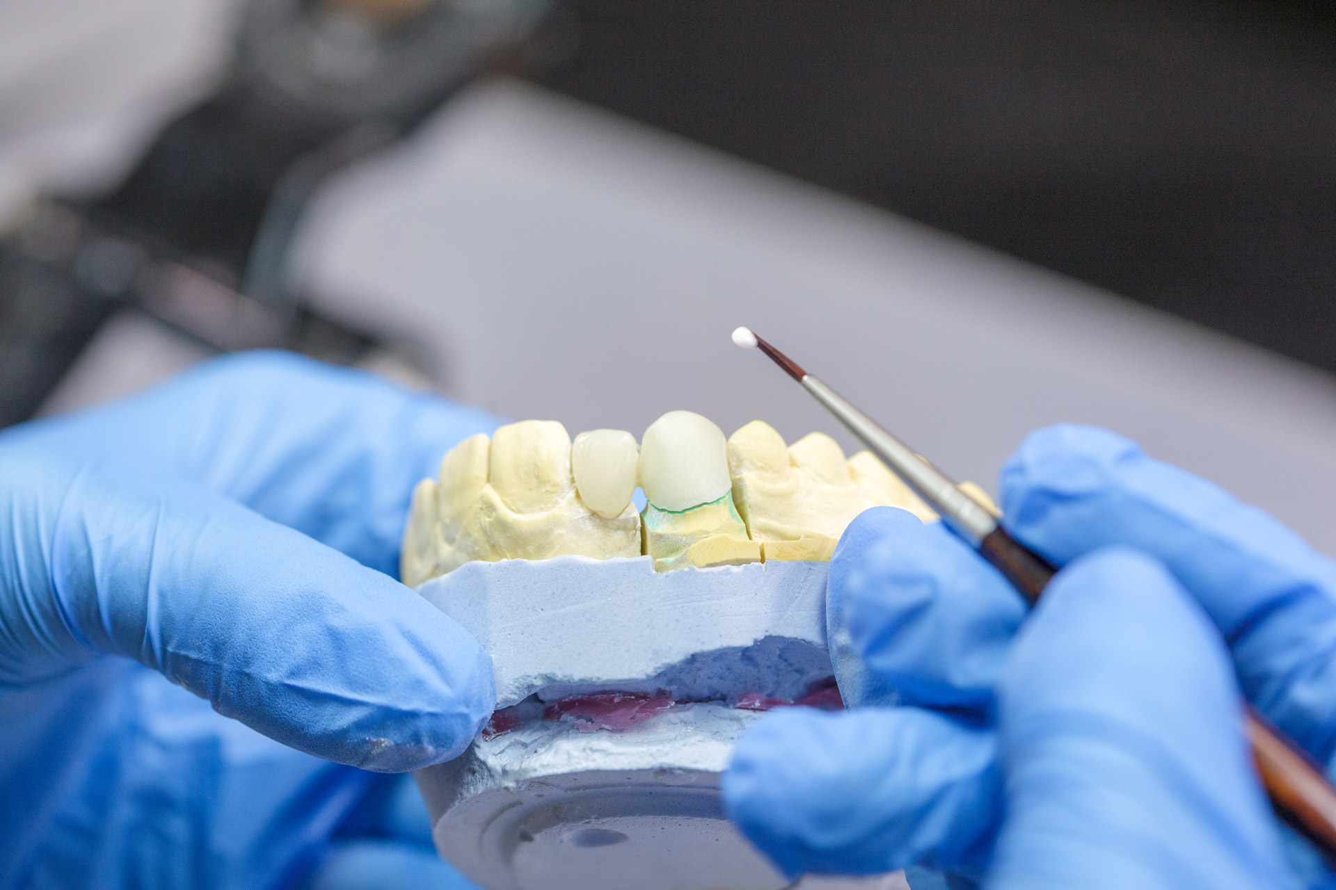 Veneers – Zahnwerk Dreilinden Berlin